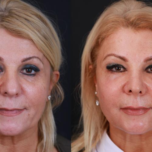 Before after photos of our patients 4